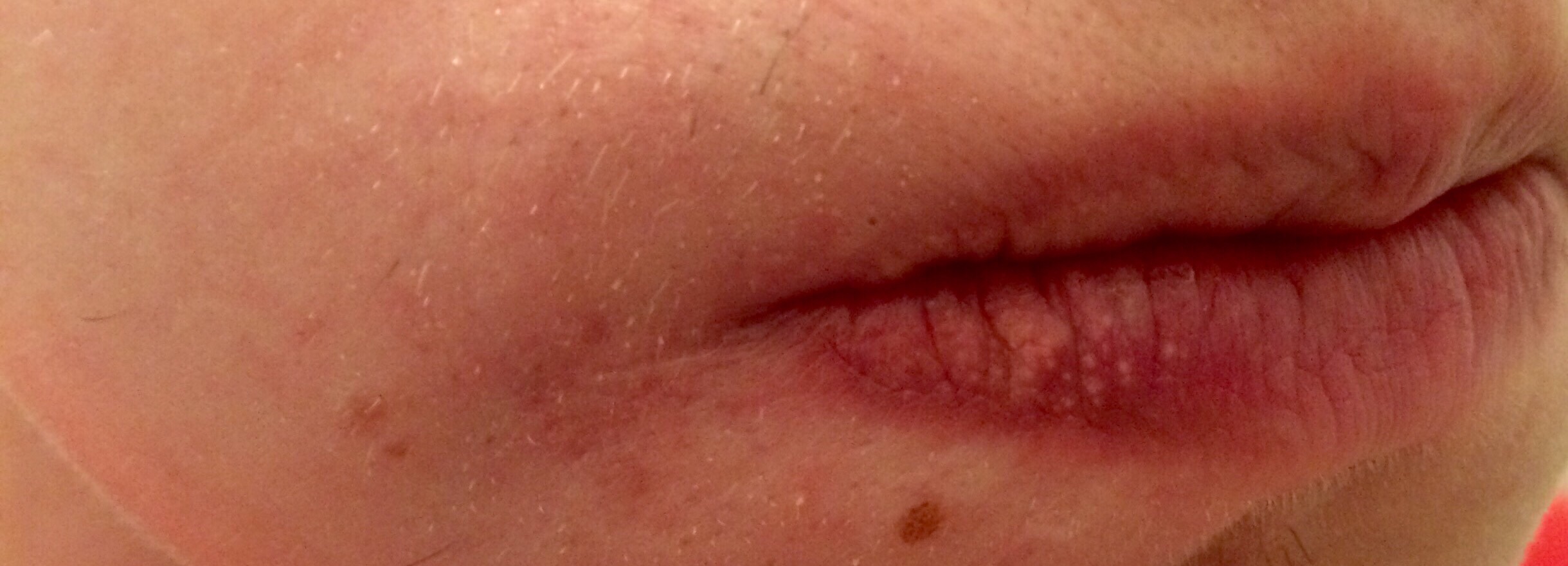 38+ Pickel In Der Lippe Innen Gif 38+ Pickel In Der Lippe Innen Gif
