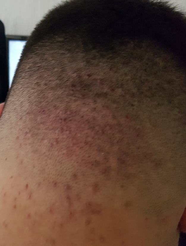 Rote Pickel, Akne, Punkte am Hinterkopf was ist das? (Gesundheit, Hautpflege) pickel hinterkopf