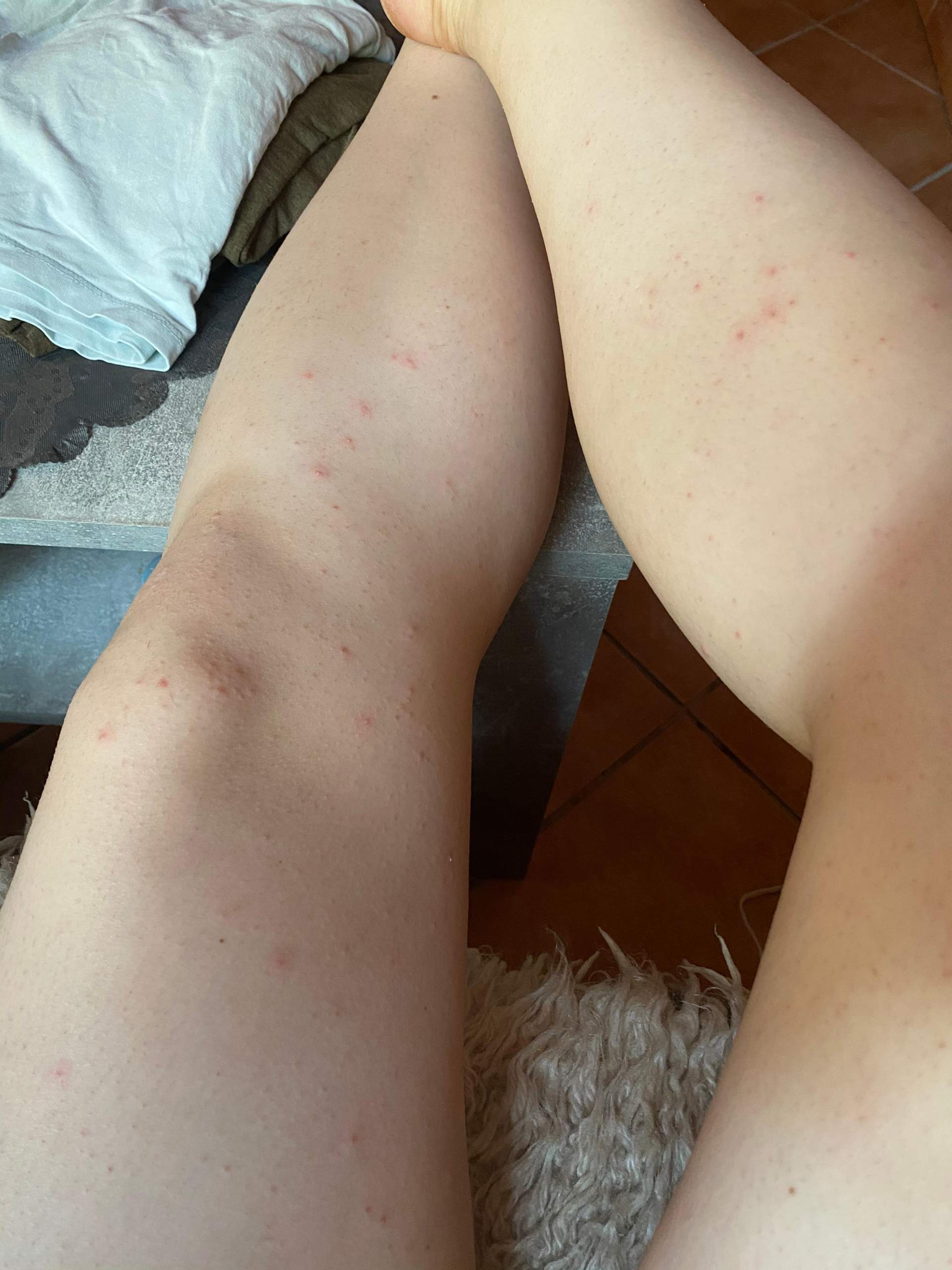 rote pickel an beinen nach epilieren gesundheit und medizin haut epilierer