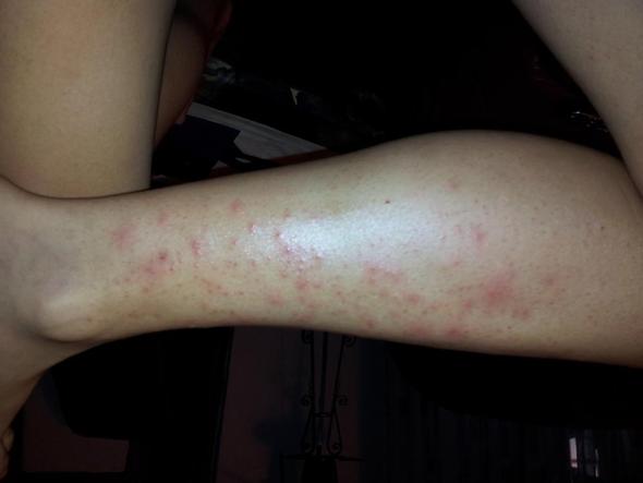 Rote Pickel An Den Beinen Was Nun Tun Gesundheit Haut Beine