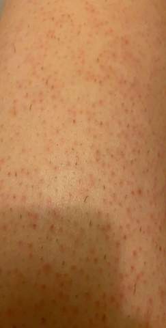 rote pickel nach epilation haare