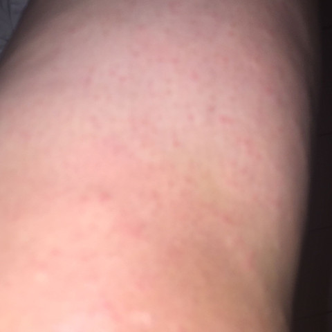 Rote Pickel Nach Rasur Was Tun Madchen Pubertat Rasieren