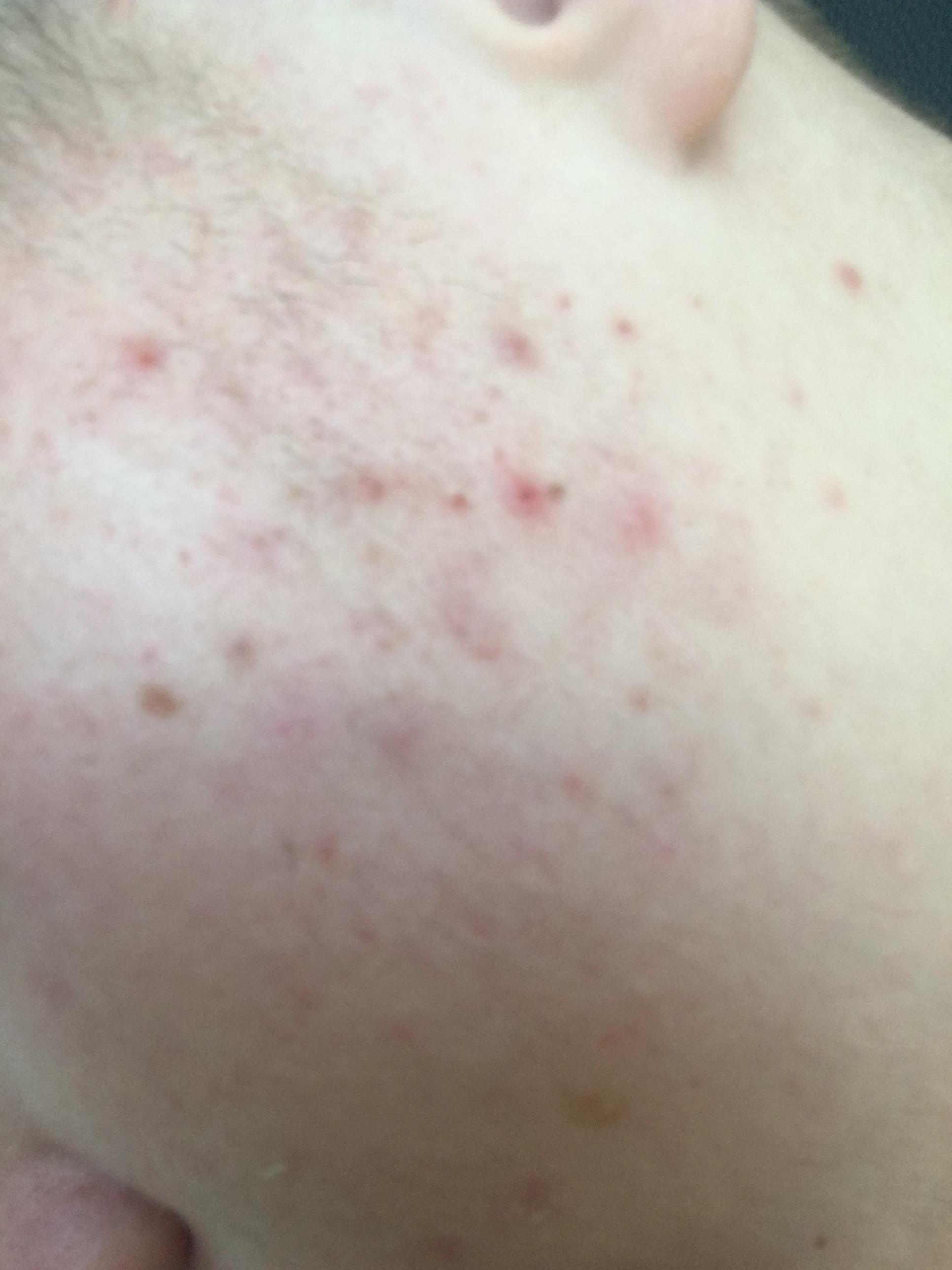 Rote Pickel Rückstände auf der haut?