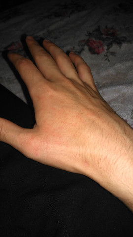 Rote Pickeln Am Hand Gesundheit Und Medizin Pickel Rot Rote Pickeln Am Hand Gesundheit Und Medizin Pickel Rot