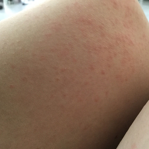 Mein Knie - (Haut, Allergie, Pocken)
