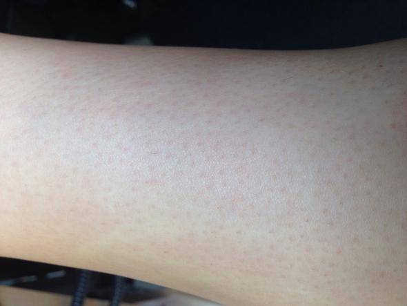 Mein Bein - (Haut, Dermatologie)