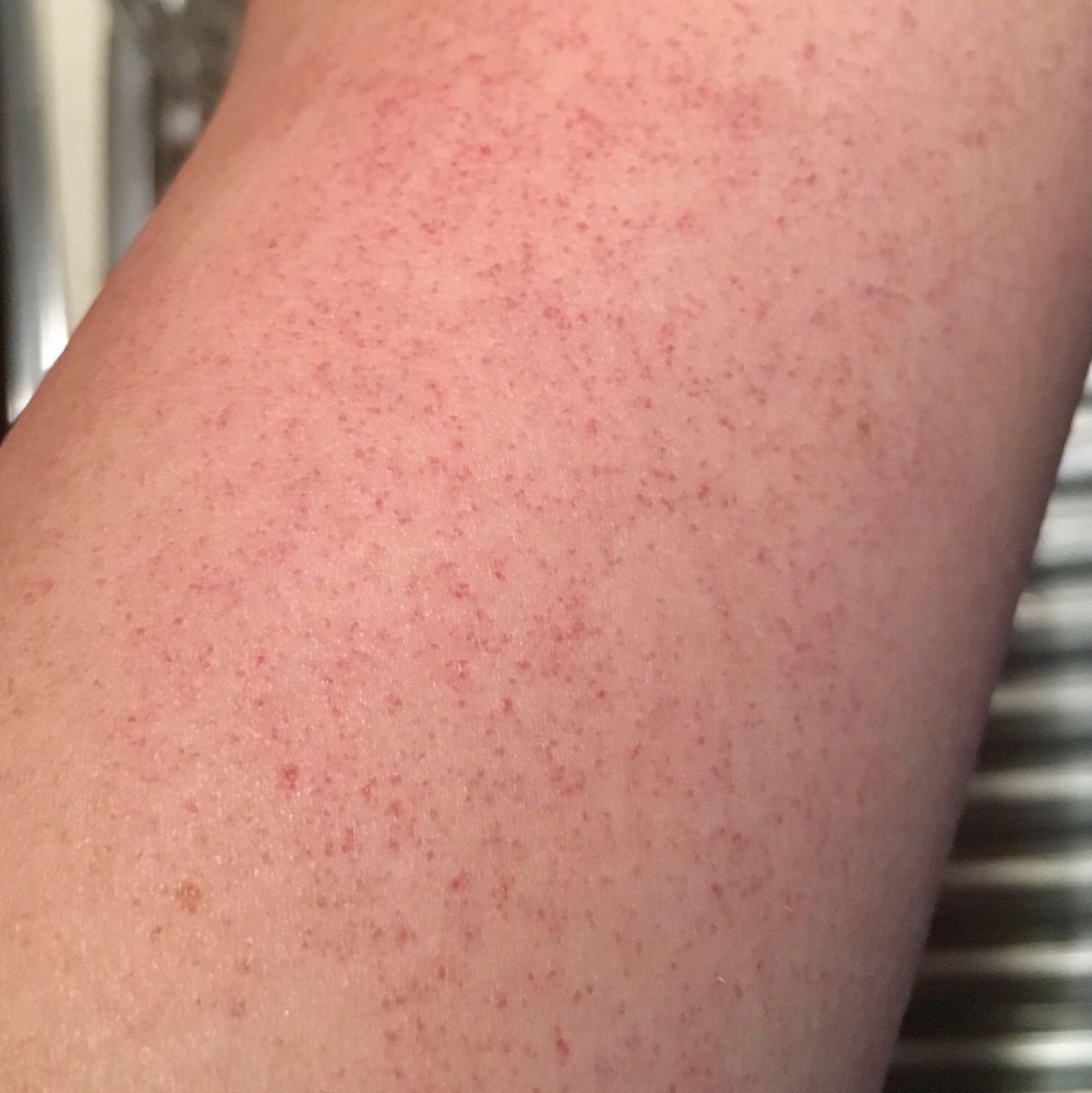 Rote Pünktchen am Arm? (Gesundheit und Medizin, rot) Rote Pünktchen am Arm? (Gesundheit und Medizin, rot)