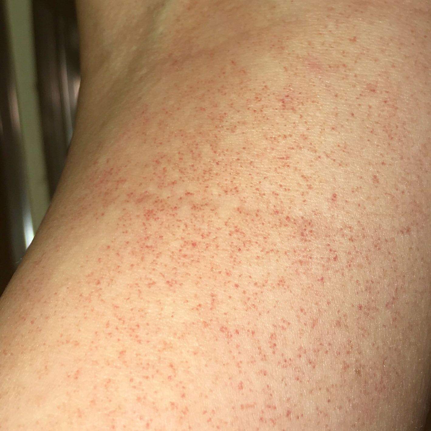 Rote Pünktchen am Arm? (Gesundheit und Medizin, rot) Rote Pünktchen am Arm? (Gesundheit und Medizin, rot)