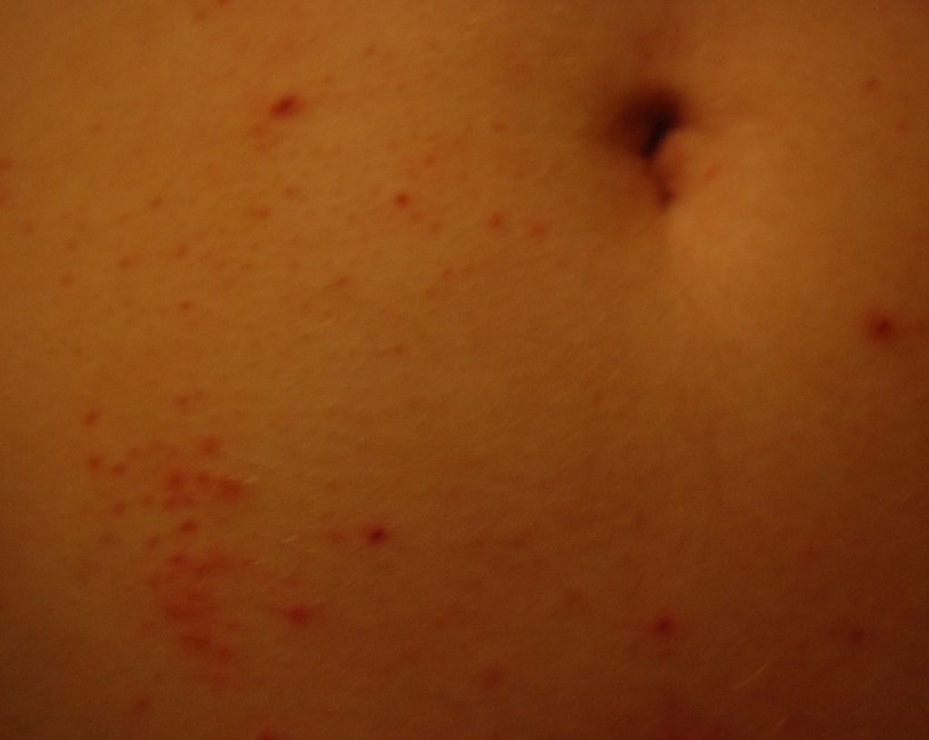 rote Pünktchen am bauch machnmal brennen und jucken? (Haut, Pickel)