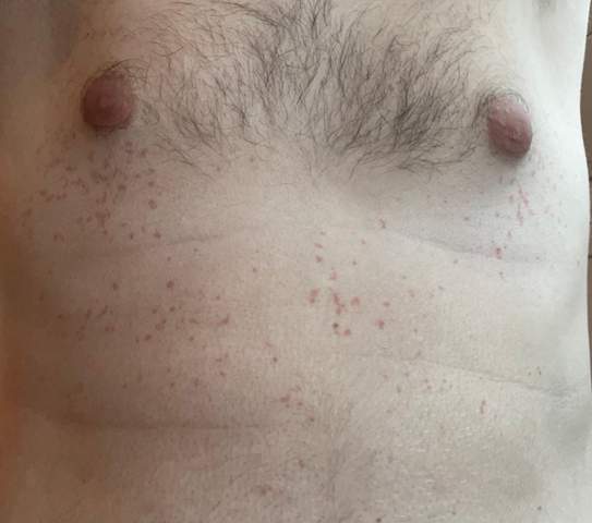 Rote Pünktchen auf der Brust? (Gesundheit und Medizin, Haut, Ausschlag)