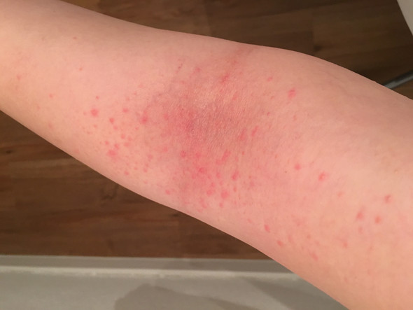Rote Pünktchen in Armbeuge - (rot, Ausschlag)