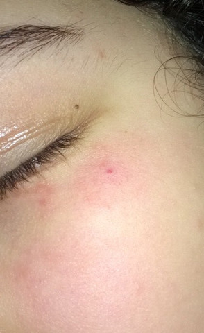 Rote Punktchen Ausschlag Unter Dem Auge Haut