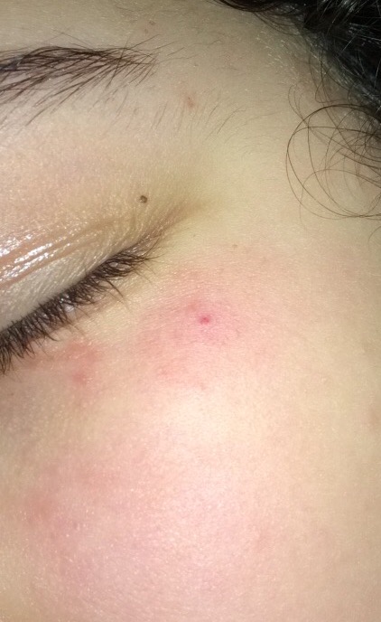 Rote Pünktchen/Ausschlag unter dem Auge? (Haut)