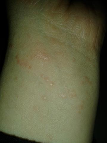 Rote Punkte Am Arm Was Ist Das Haut Ausschlag Rote Punkte Rote Punkte Am Arm Was Ist Das Haut Ausschlag Rote Punkte