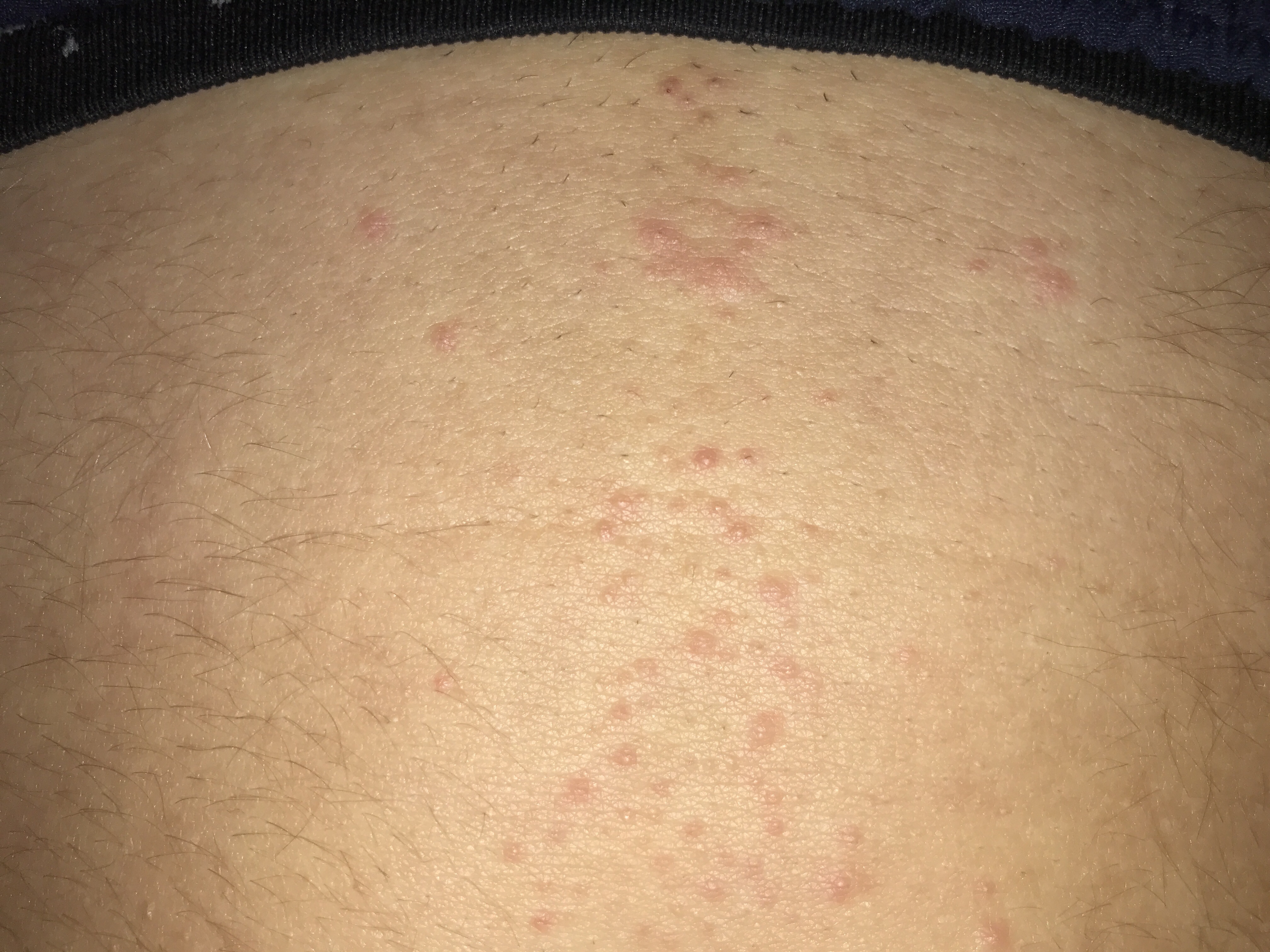 Rote Punkte am Bauch (evtl. wegen Rasur)? (Pubertät, Hautpflege Rote Punkte am Bauch (evtl. wegen Rasur)? (Pubertät, Hautpflege