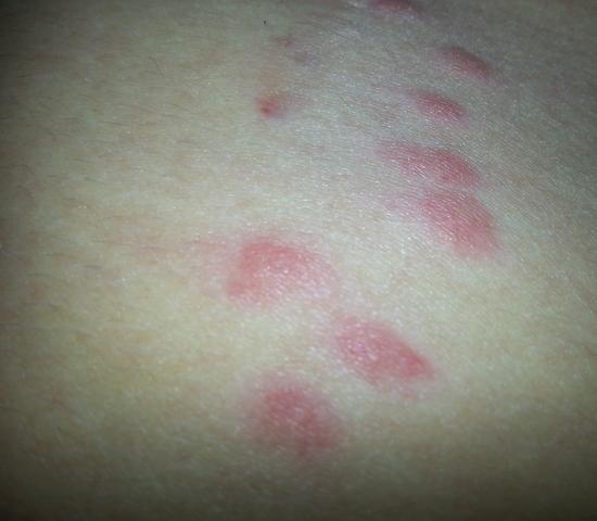 Rote punkte am bauch?!? Was ist das (Krankheit, Insekten) Rote punkte am bauch?!? Was ist das (Krankheit, Insekten)