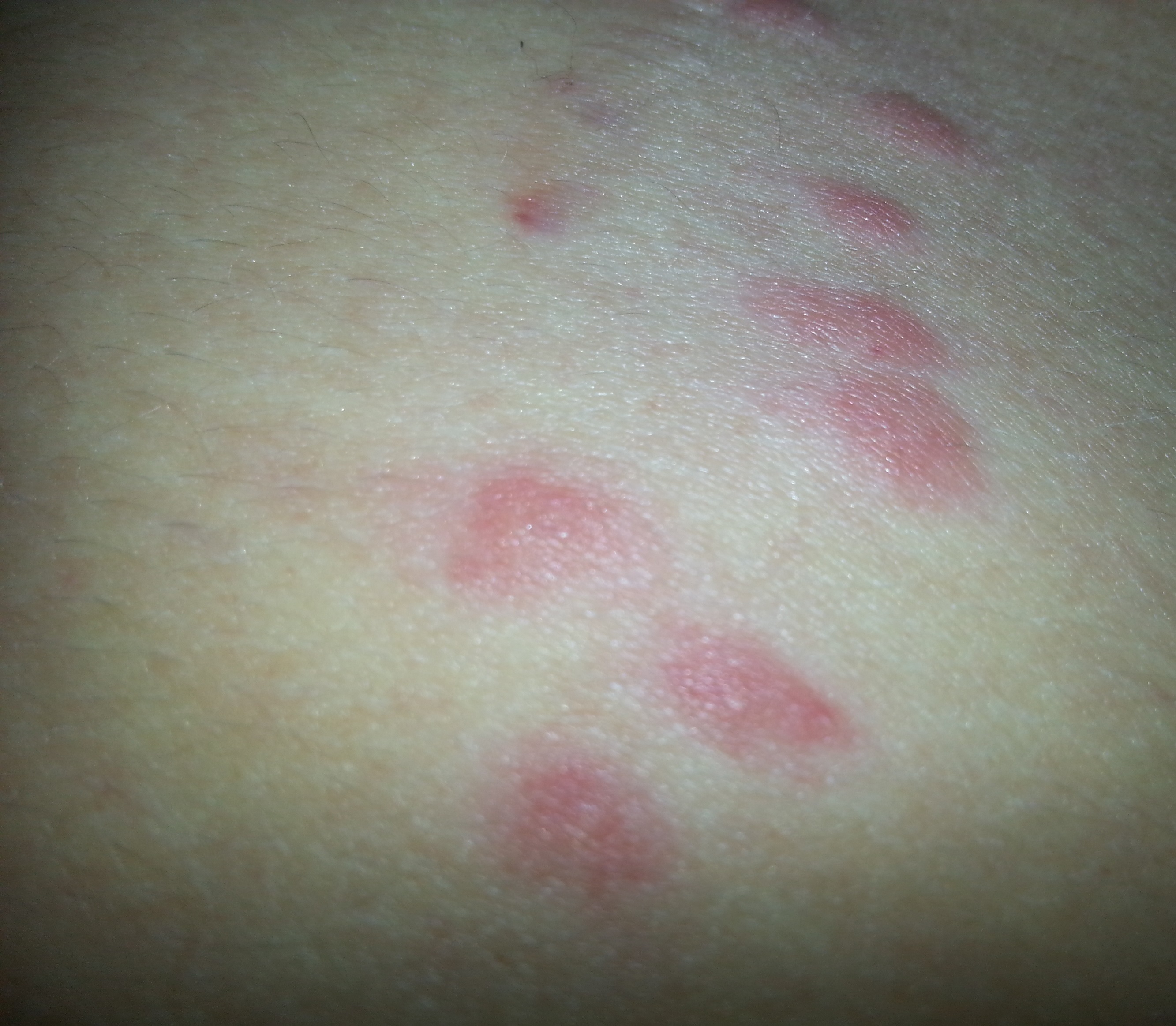 Rote punkte am bauch?!? Was ist das (Krankheit, Insekten) Rote punkte am bauch?!? Was ist das (Krankheit, Insekten)