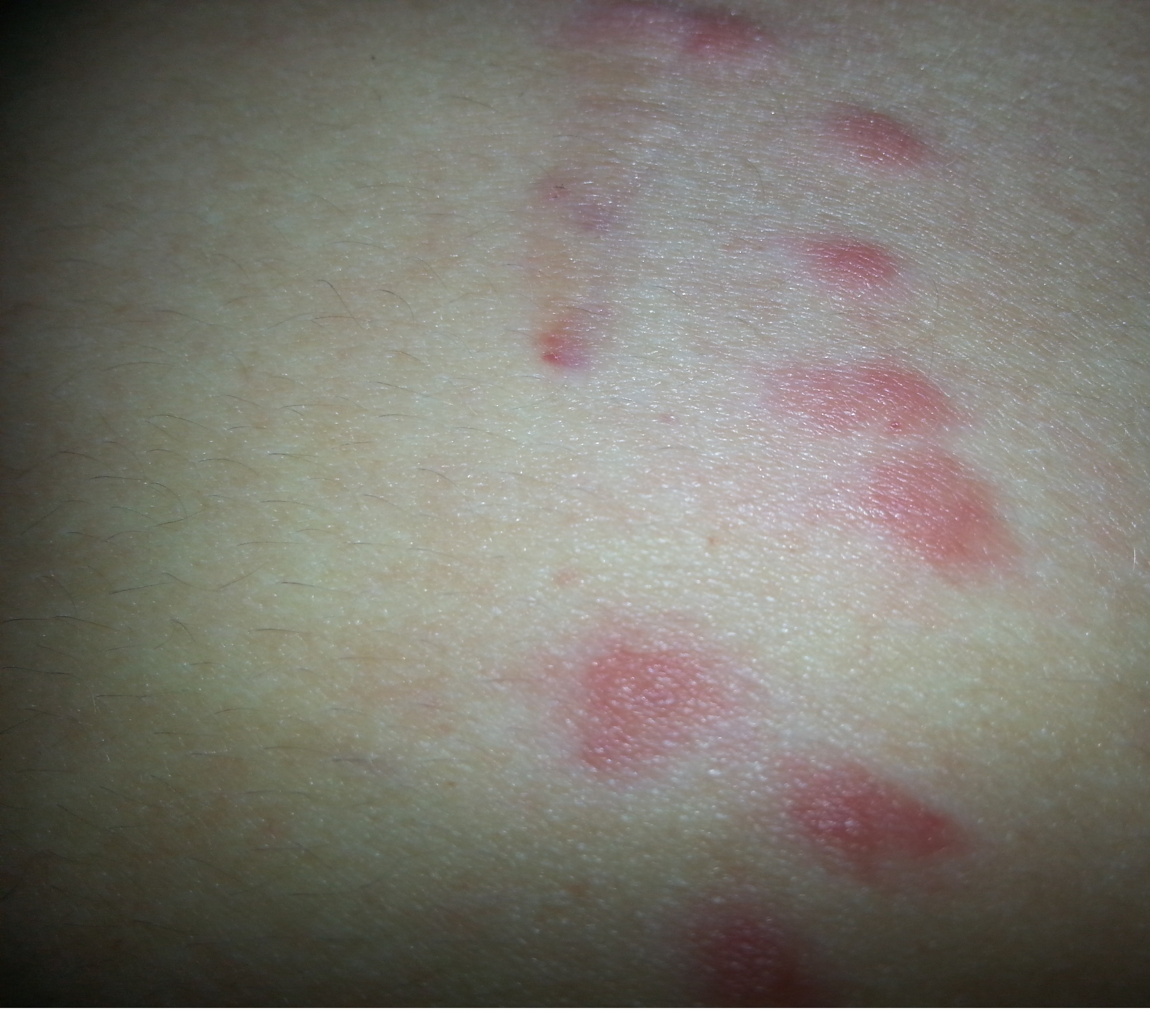 Rote punkte am bauch?!? Was ist das (Krankheit, Insekten) Rote punkte am bauch?!? Was ist das (Krankheit, Insekten)