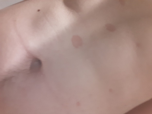 Rote Punkte Am Bauch Was Tun Gesundheit Krankheit Rote Punkte Am Bauch Was Tun Gesundheit Krankheit