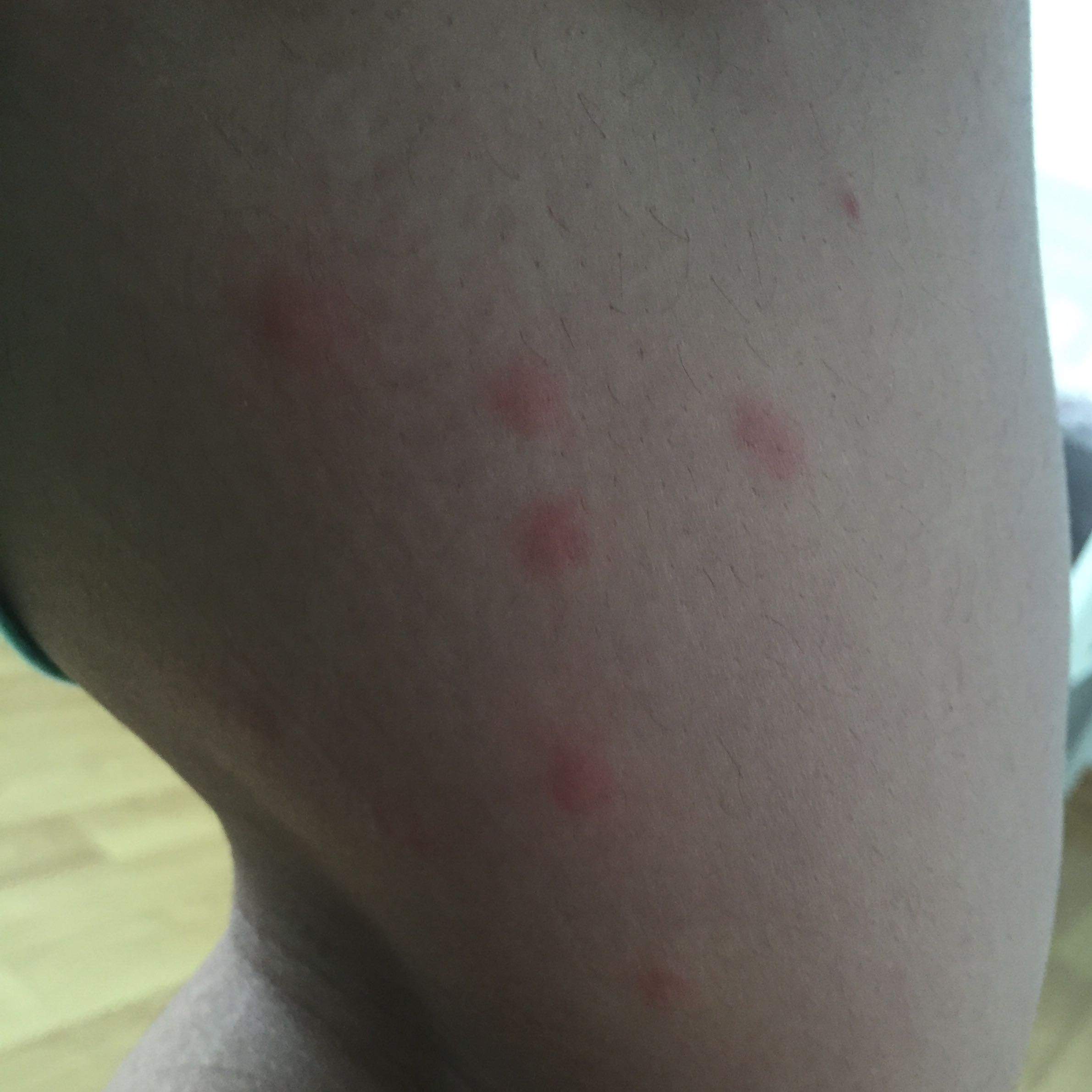 Rote Punkte am Körper die jucken + Bild? (Arzt, Stich)