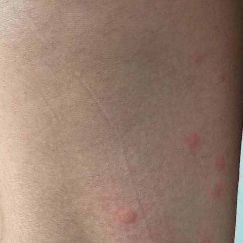 Mückenstiche können das nicht sein  - (Arzt, Stich)