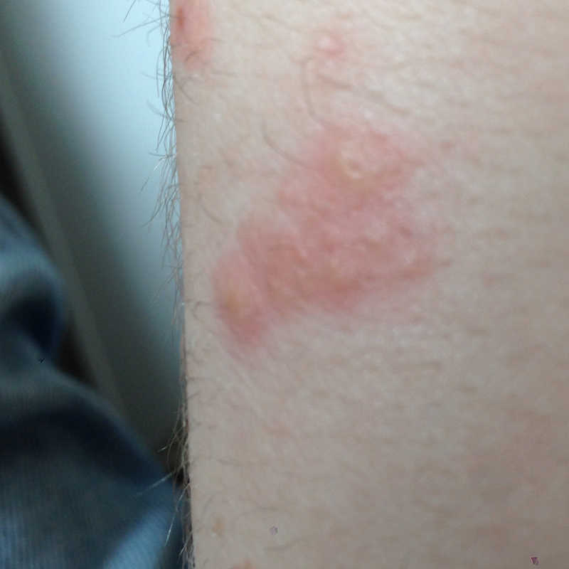 Rote Punkte an den Armen die Jucken (Hand, rot, Arm)