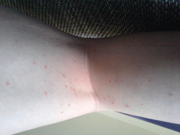 Rote Punkte An Den Beinen Ohne Juckreiz Ausschlagartig Gesundheit Krankheit Haut Rote Punkte An Den Beinen Ohne Juckreiz Ausschlagartig Gesundheit Krankheit Haut