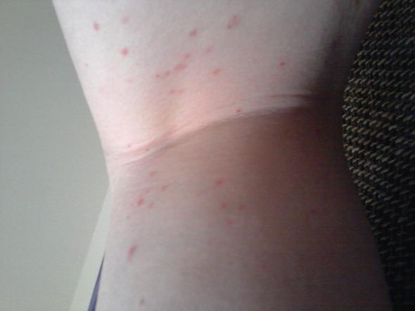 Rote Punkte An Den Beinen Ohne Juckreiz Ausschlagartig Gesundheit Krankheit Haut Rote Punkte An Den Beinen Ohne Juckreiz Ausschlagartig Gesundheit Krankheit Haut