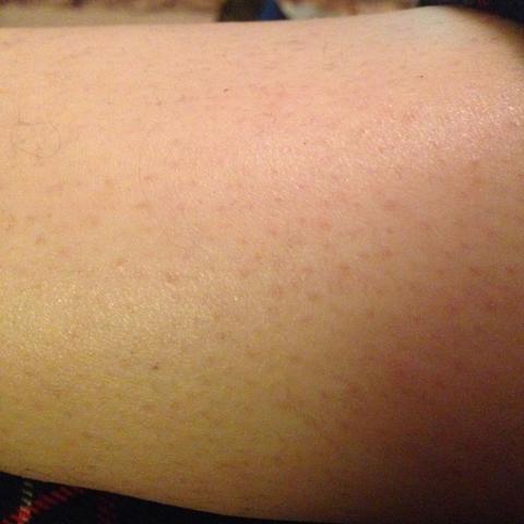 Rote Punkte An Den Beinen Rasur Beine Rot Creme