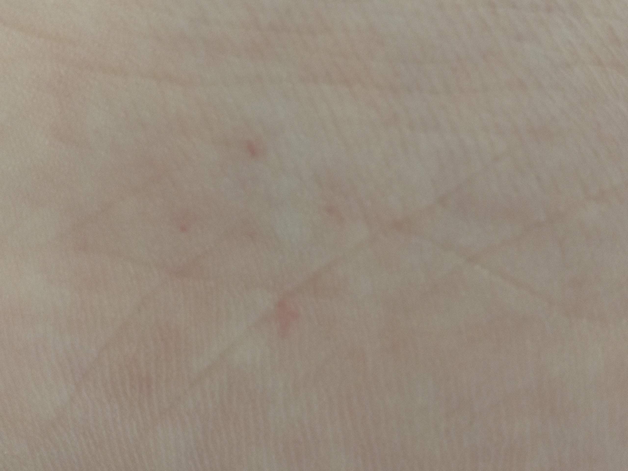 Rote Punkte an der Fußsohle? (Gesundheit, Füße, rotepunkte)