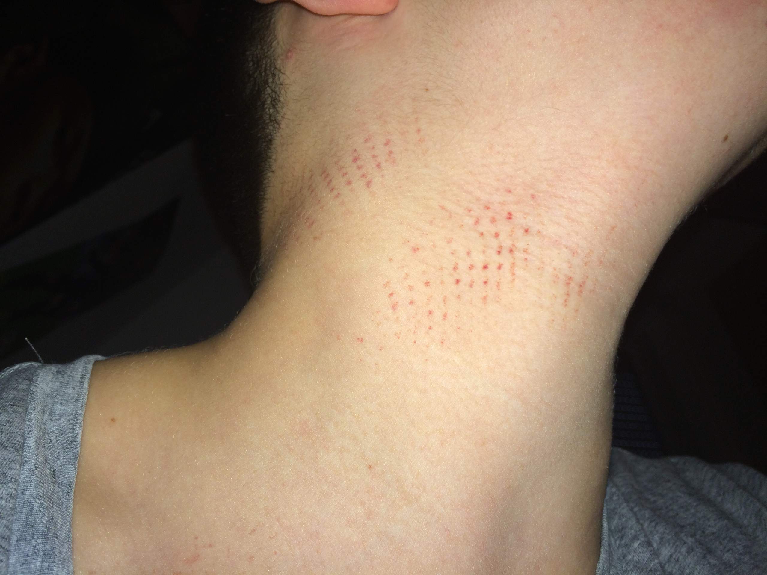 Rote Punkte an Hals und bisschen am Handgelenk (Angst, Ausschlag) Rote Punkte an Hals und bisschen am Handgelenk (Angst, Ausschlag)