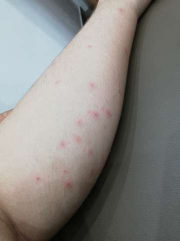 Rote Punkte an mein Bein? (Gesundheit, Körper, Pickel) pickel auf beinen