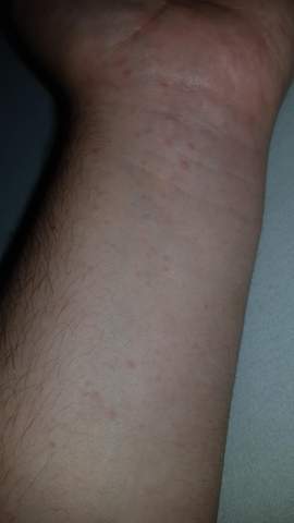 Rote Punkte Auf Arm Und Hande Hautpilz Gesundheit Und Medizin Haut Rote Punkte Rote Punkte Auf Arm Und Hande Hautpilz Gesundheit Und Medizin Haut Rote Punkte