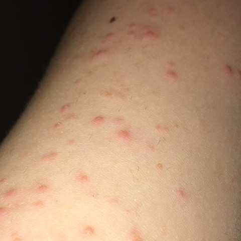 Rote Punkte Auf Arm Was Kann Das Sein Wie Bekomme Ich Es Weg Pickel Sommer T Shirt Rote Punkte Auf Arm Was Kann Das Sein Wie Bekomme Ich Es Weg Pickel Sommer T Shirt