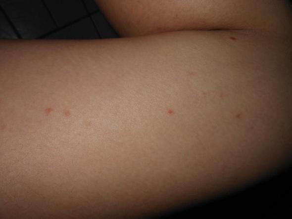 Rote Punkte Auf Beinen Gesundheit Haut Rote Punkte Auf Beinen Gesundheit Haut