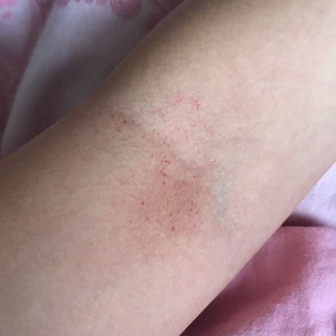 Rote Punkte Auf Dem Arm Gesundheit Rote Punkte Rote Punkte Auf Dem Arm Gesundheit Rote Punkte