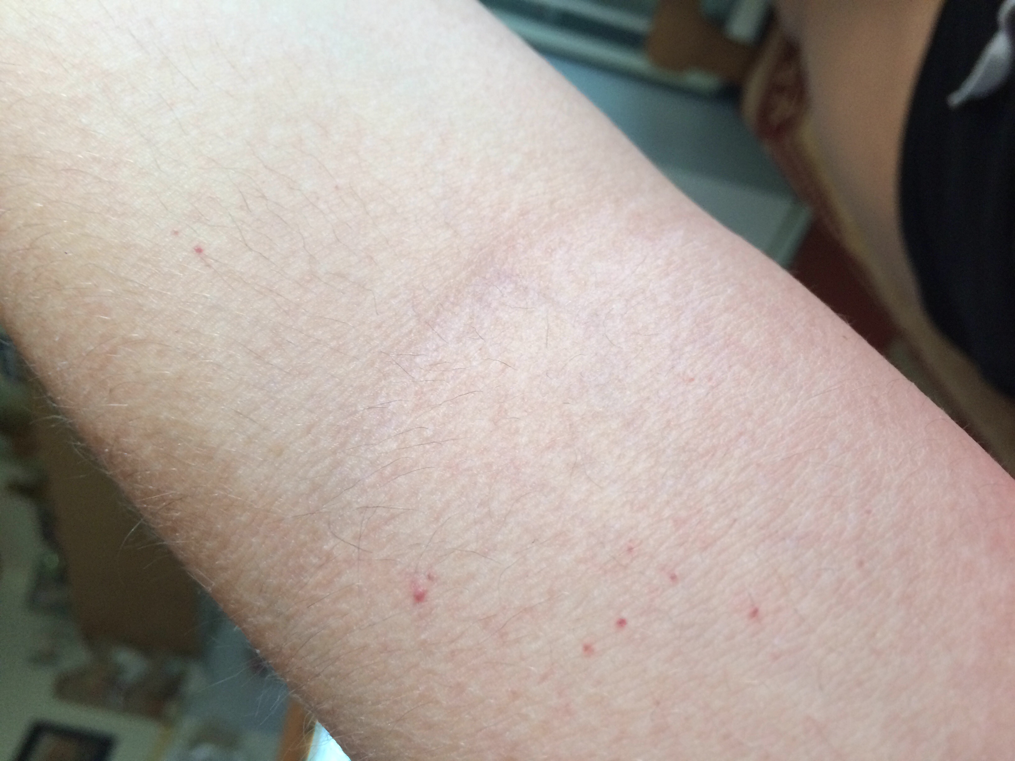 Rote Punkte auf dem Arm hab ich eine Allergie? (Haut) Rote Punkte auf dem Arm hab ich eine Allergie? (Haut)