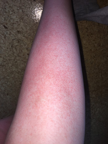 Rote Punkte Auf Den Beinen Nach Solarium Hitze Braune