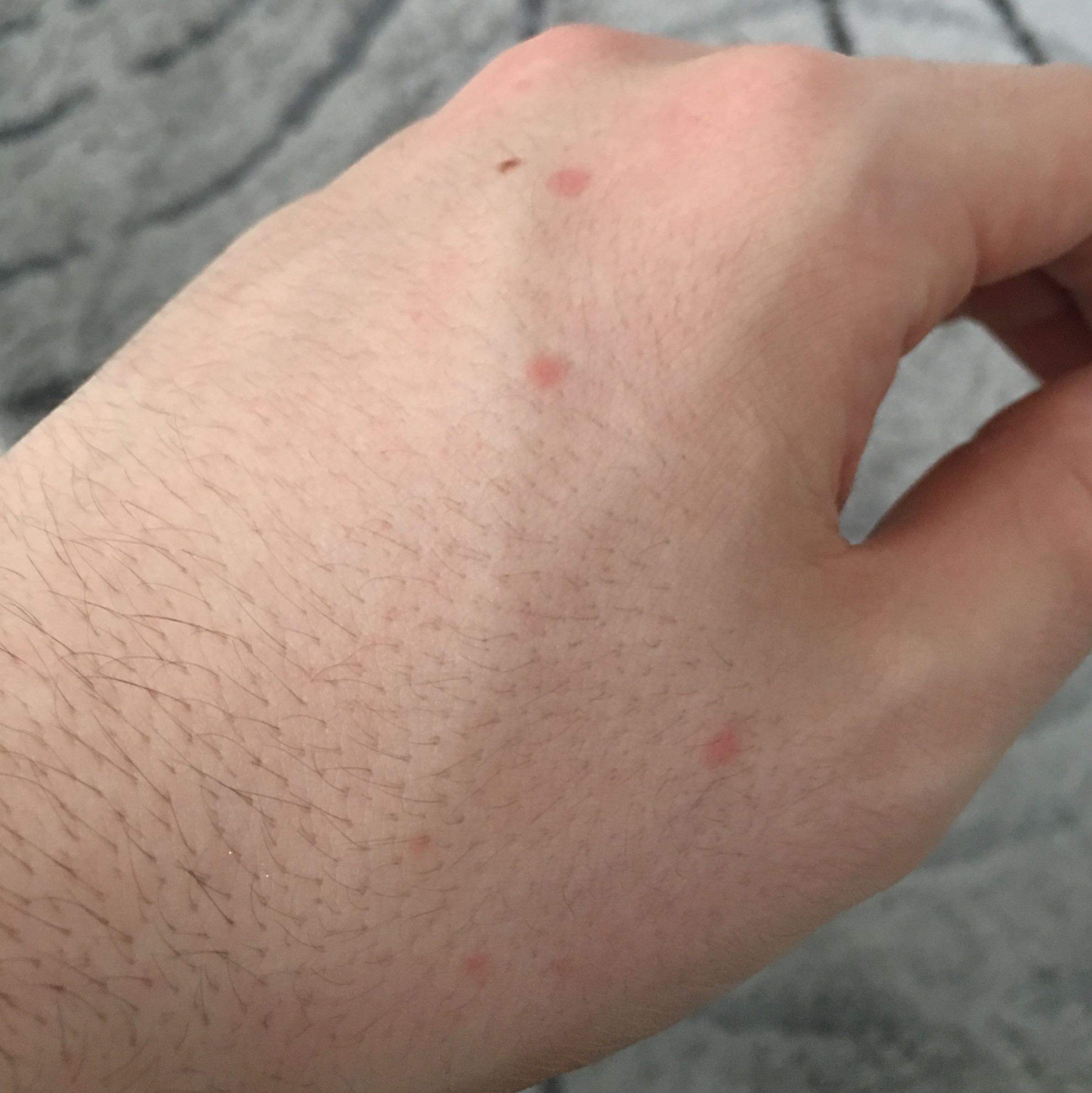 Rote Punkte auf den Händen (Pulverbeschichtung)? (Arzt, Krankheit, Haut)