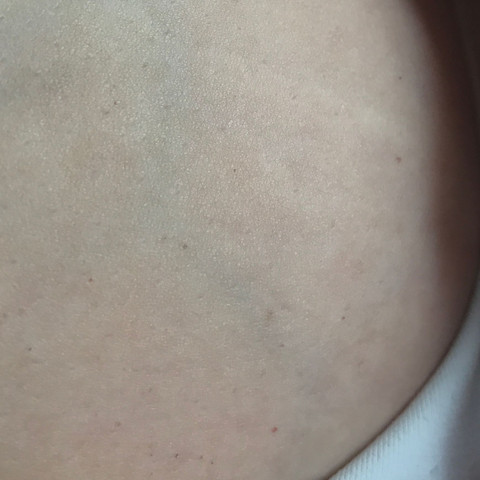 Punkte der brust auf rote Hautrötungen unter