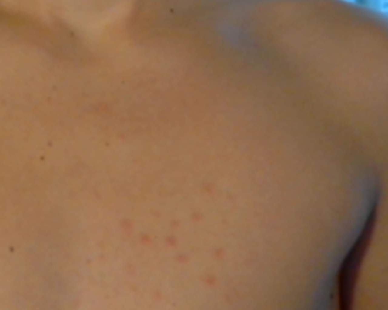 Rote punkte auf der brust