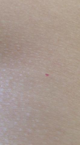 Rote Punkte Auf Der Haut Was Ist Das Erkrankung Medizin Krankheit Blut Rote Punkte Auf Der Haut Was Ist Das Erkrankung Medizin Krankheit Blut