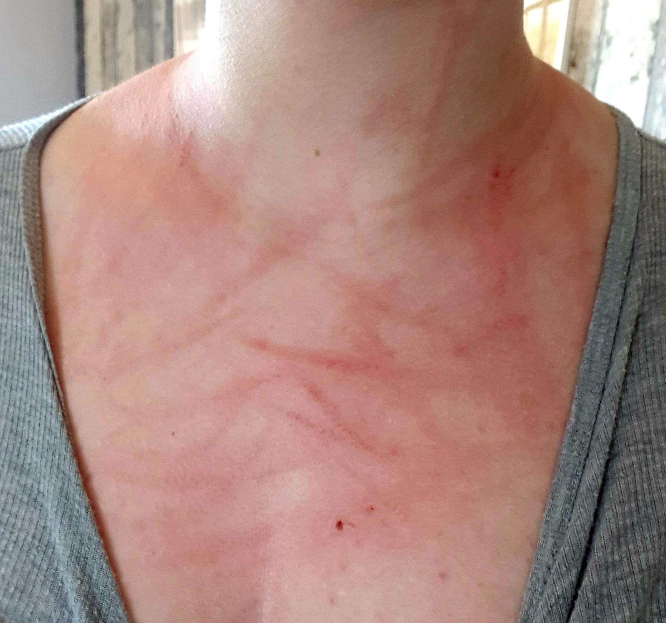 Rote Punkte auf der Haut? (Gesundheit und Medizin, Gesundheit)