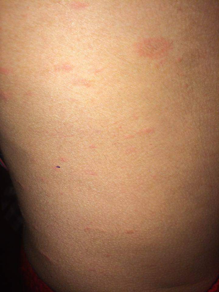 Kleine Rote Punkte Auf Dem Bauch