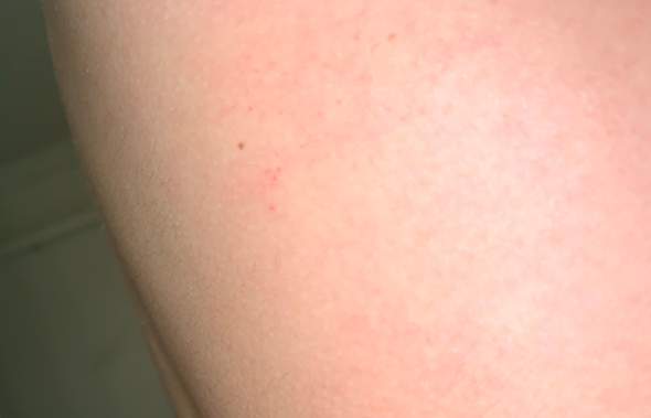 Rote Punkte Auf Der Haut Muss Ich Mir Sorgen Machen Gesundheit Und Medizin Krankheit Rote Punkte Auf Der Haut Muss Ich Mir Sorgen Machen Gesundheit Und Medizin Krankheit