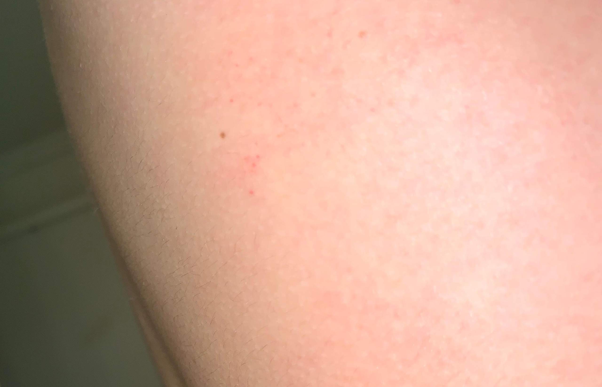 Der auf rote haut blutpünktchen Hautrötungen: Ursachen,