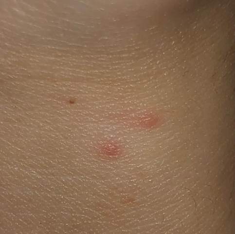 Rote Punkte Auf Der Haut Ohne Juckreiz Hautarzt Stich Rotung