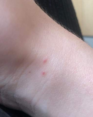 Rote Punkte Auf Der Haut Ohne Juckreiz Hautarzt Stich Rotung