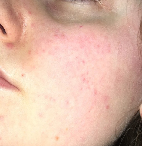 Rote Punkte Auf Der Wange Und Der Nase Gesundheit Haut Hautpflege