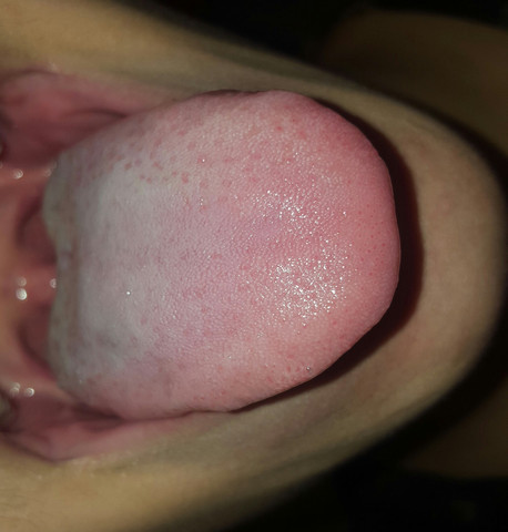 Rote Punkte Auf Der Zunge Was Ist Das Gesundheit Medizin Rote Punkte Auf Der Zunge Was Ist Das Gesundheit Medizin